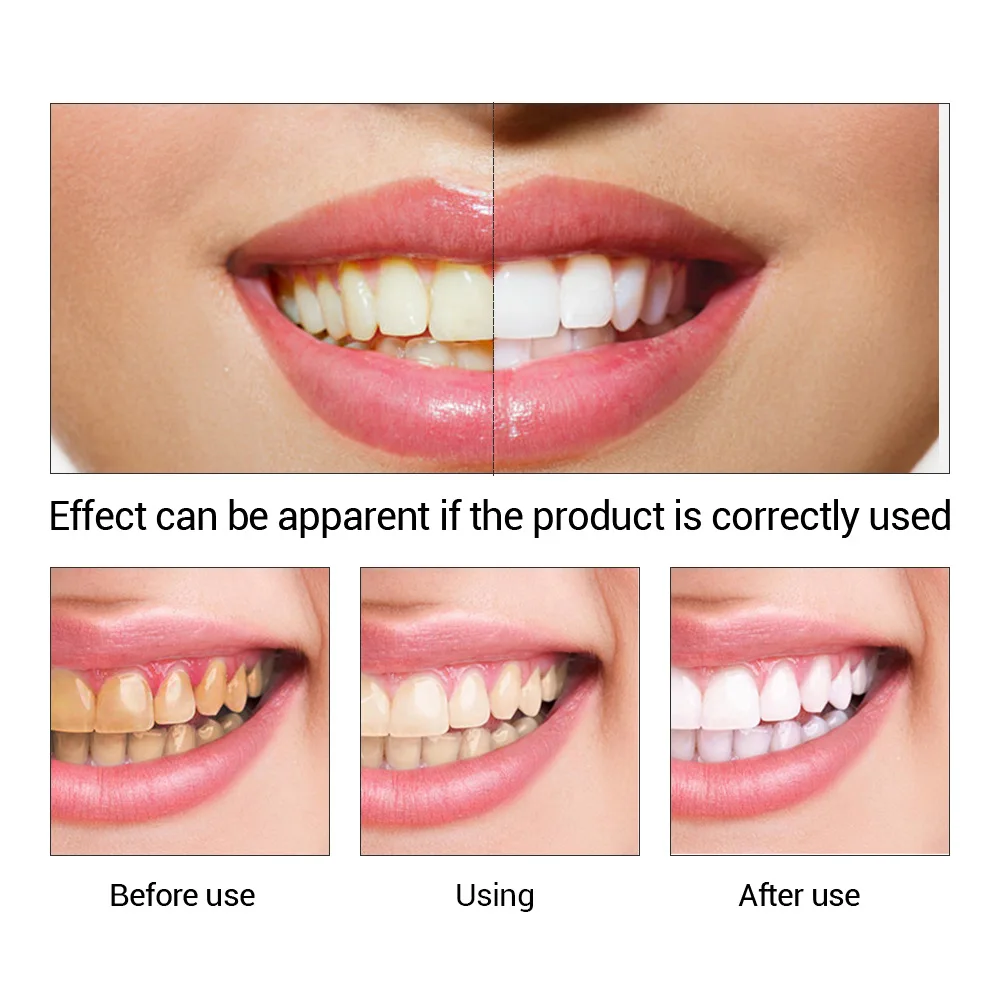 FTEENPLY poudre d'essence de b - Teeth Whitening Near Me avis et prix