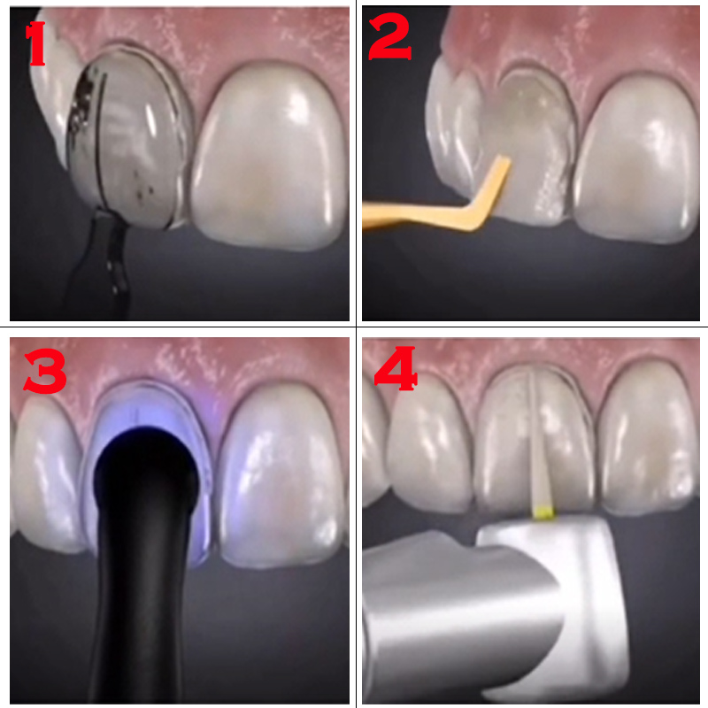 Kit de 32 pièces pour blanchim - Teeth Whitening Moulds avis et prix