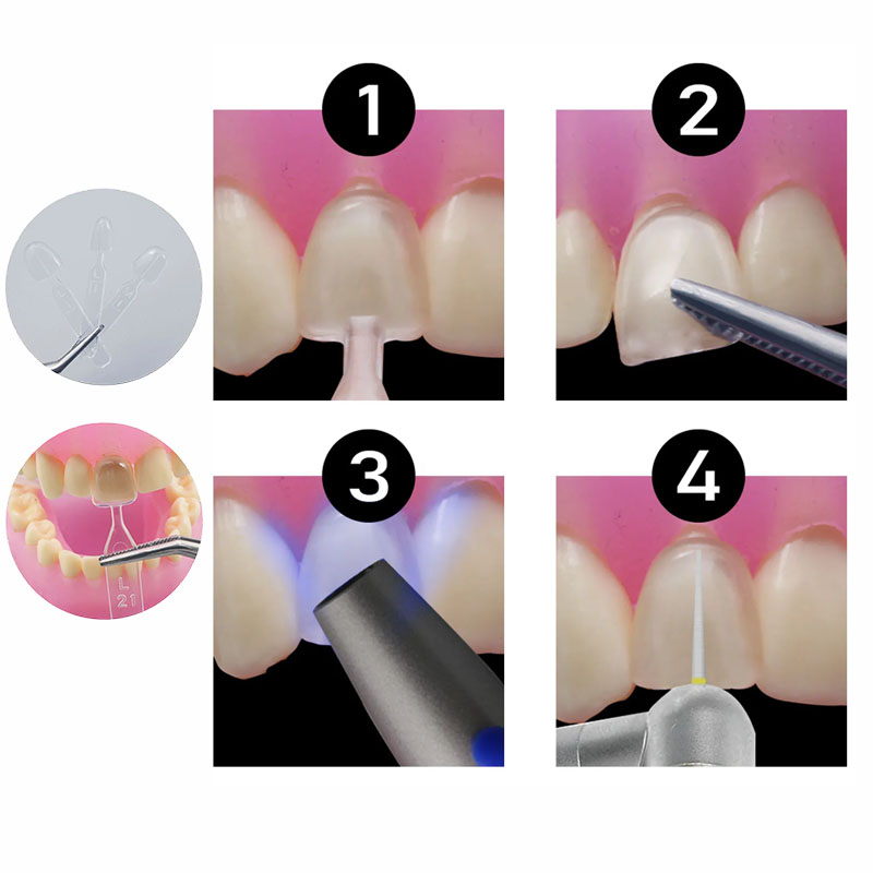 Kit de moules dentaires en rés - Teeth Whitening Moulds avis et prix