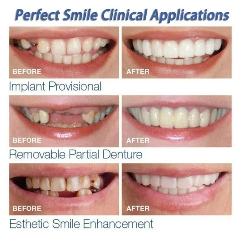 Kit de dents en placage à clip - Teeth Whitening Kit avis et prix