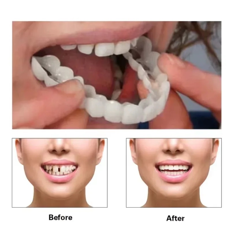 Kit de dents en placage à clip - Teeth Whitening Kit avis et prix